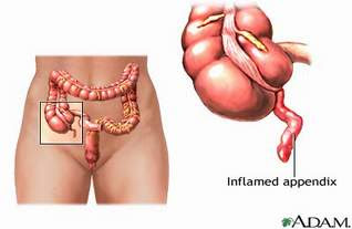 Clinical Manifestations of Appendicitis