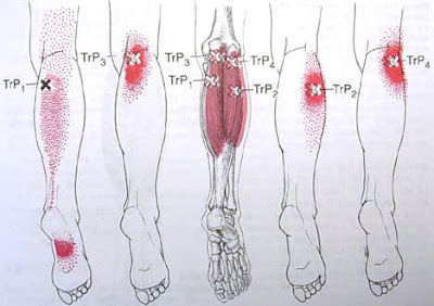 MIOTERAPIA