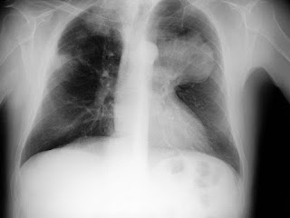 Types of Mesothelioma