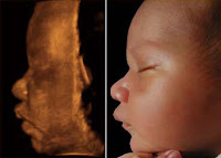 3d Ultrasound Baby5