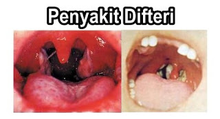 penyakit difteri penyakit difteri