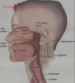 Nasopharynx cancer