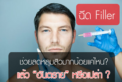 ฉีด Filler รักษาหลุมสิว