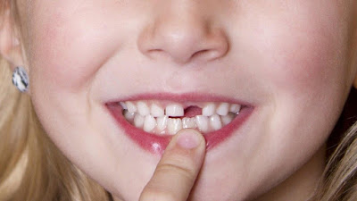 Cắm Implant răng cửa như thế nào?