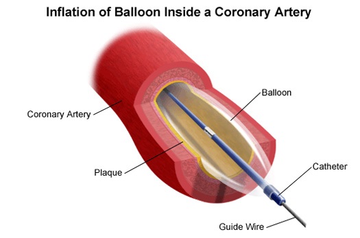 Balloon Angioplasty