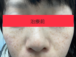 IPL（光治療）でそばかす治療3回目照射の効果