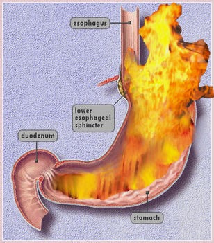  Gastroesophageal reflux disease (GERD)   What is gastroesophageal reflux disease (GERD)? Reflux means that stomach acid and juices flow from the stomach back up into the tube that leads from the throat to the stomach (oesophagus). This causes heartburn when you have heartburn at least 2 times a week; it is called gastroesophageal reflux disease, or GERD.  Eating too much or bending forward after eating sometimes causes heartburn and a sour taste in the mouth. But having heartburn from time to time doesn't mean you have GERD. With GERD, the reflux—and heartburn—last longer and come more often. If this happens to you, it is important to treat it, because GERD can cause ulcers and damage to the oesophagus.   Causes for GERD Normally when you swallow your food, it travels down the food pipe (oesophagus) to a valve that opens to let the food pass into the stomach and then closes. With GERD, the valve doesn't close tightly enough. Stomach acid and juices flow from the stomach and back up (reflux) into the oesophagus.    Symptoms for GERD The main symptom of GERD is heartburn. It may feel like a burning, warmth, or pain just behind the breastbone. It is also common to have symptoms at night when you are trying to sleep. If you have pain behind your breastbone, it is important to make sure it is not caused by a problem with your heart. The burning sensation caused by GERD usually occurs after you eat. Pain from the heart usually feels like pressure, heaviness, weight, tightness, squeezing, discomfort, or a dull ache. It occurs most often after you are active.   GERD diagnosis  First, your doctor will do a physical exam and ask you questions about your health. You may or may not need further tests. Your doctor may just treat your symptoms by prescribing medicines that reduce or block stomach acid. These include H2 blockers (for example, Pepcid) or proton pump inhibitors (for example, Prilosec). If your heartburn goes away after you take the medicine, your doctor will likely diagnose GERD.  In some cases doctors do tests to be sure that you have GERD or to look for other problems.  Endoscopy is a test that lets the doctor look at the inside of your oesophagus and stomach through a tiny camera in a thin, flexible, lighted tube (endoscope).  Oesophagus testing is a group of tests that check the condition of the oesophagus and how well it works.  An upper gastrointestinal serious helps your doctor examine the upper part of your digestive system. These X-rays can show other health problems that may be causing your symptoms.   Treatment for GERD For mild symptoms of GERD, over-the-counter medicines. These include H2 blockers (for example, Pepcid) or a proton pump inhibitor (for example, Prilosec OTC). Changing your diet, losing weight, and making other lifestyle changes can also help. For severe symptoms of GERD, your doctor may prescribe medicine along with lifestyle changes. Your doctor may recommend surgery if medicine doesn't work or if you can't take it because of the side effects. For example, fundoplication surgery strengthens the valve between the oesophagus and stomach. But many people continue to need some medicine even after surgery. GERD is common in pregnant women. It doesn't usually cause problems or harm the baby (foetus). Pregnant women with GERD can take antacids to treat their symptoms, but they should talk to their doctors before using other medicines. Some medicines may not be safe to take during pregnancy. Most of the time, symptoms get better after the baby is born. Usually allopathic medicine have limited role to control GERD, Symptomatic  HOMOEOPATHIC MEDICINES HELPs for GERD  manage GERD Many people with GERD have it for the rest of their lives. You may need to take medicine for many years to help control the symptoms. But making certain lifestyle changes can also help.   Here are some tips that may help your symptoms: • Quit smoking or using tobacco.  • After eating, wait 2 to 3 hours before you lie down. • Raise the head of your bed 6 to 8 inches by putting blocks under the frame or a foam wedge under the head of the mattress. • If you are overweight, lose weight. Even losing a small amount of weight can help. • Wear loose-fitting clothes around your waist and midsection. This puts less pressure on the stomach. • Try to eat smaller meals more often, and avoid any foods that make you feel worse. • Use chewing gum or hard candies to increase the amount of saliva your mouth produces. Saliva washes stomach juices out of the oesophagus into the stomach and can control stomach acid.  Are you suffering with GERD For More details  Please contact   Whom to contact for GERD Treatment  Dr.Senthil Kumar Treats many cases of gastro esophageal reflux disease (GERD), In his medical professional experience with successful results. Many patients get relief after taking treatment from Dr.Senthil Kumar.  Dr.Senthil Kumar visits Chennai at Vivekanantha Homeopathy Clinic, Velachery, Chennai 42. To get appointment please call 9786901830, +91 94430 54168 or mail to consult.ur.dr@gmail.com,    For more details & Consultation Feel free to contact us. Vivekanantha Clinic Consultation Champers at Chennai:- 9786901830  Panruti:- 9443054168  Pondicherry:- 9865212055 (Camp) Mail : consult.ur.dr@gmail.com, homoeokumar@gmail.com   For appointment please Call us or Mail Us  For appointment: SMS your Name -Age – Mobile Number - Problem in Single word - date and day - Place of appointment (Eg: Rajini – 30 - 99xxxxxxx0 – GERD – 21st Oct, Sunday - Chennai ), You will receive Appointment details through SMS