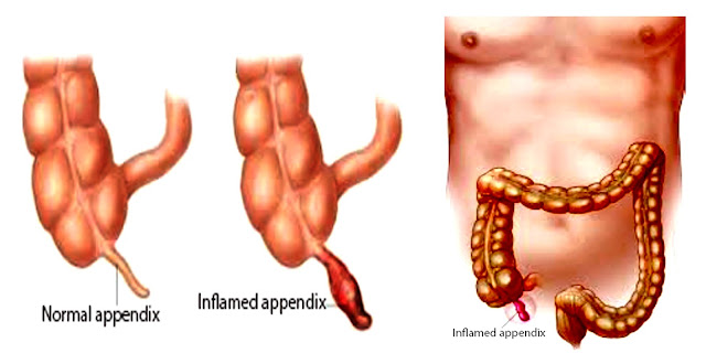 Appendicitis.