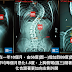 可怕的脊椎側彎-別讓自己活在後悔中