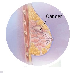 All About Breast Cancer | Causes, Symptoms, Prevention And Related Information