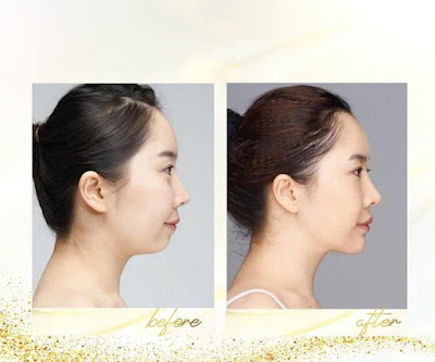 tiêm filler cằm trước và sau