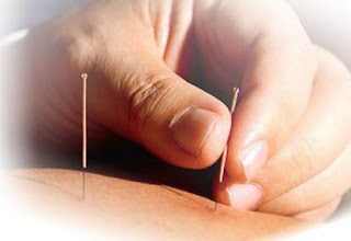 pengobatan akupuntur
