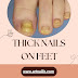 Thick Nails on Feet: Causes, Treatment, and Prevention