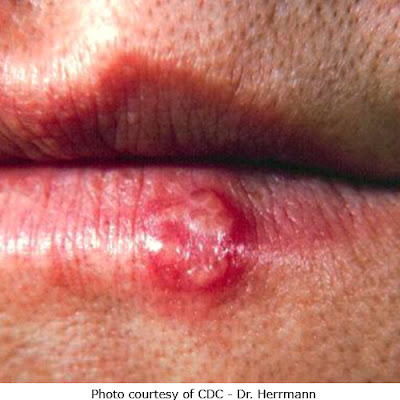 Caused of cold sores or fever