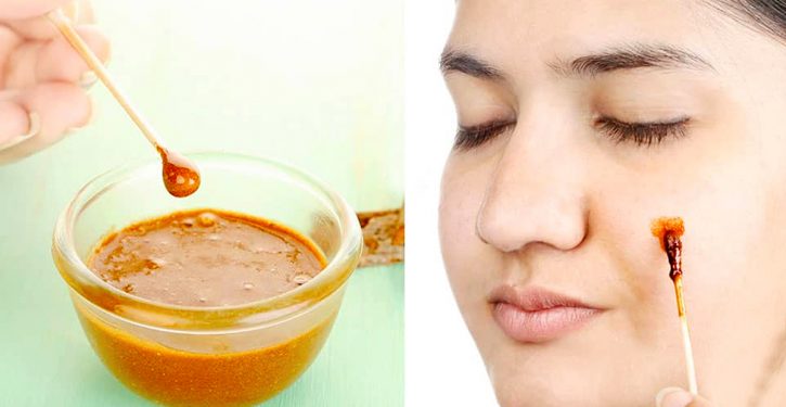 A Magical Remedy With Lemon And Cinnamon To Get Rid Of Facial Acne