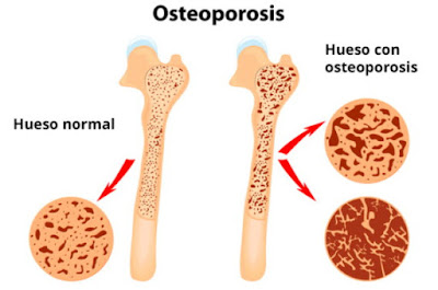 Vista de un hueso normal y otro de un hueso con osteoporosis