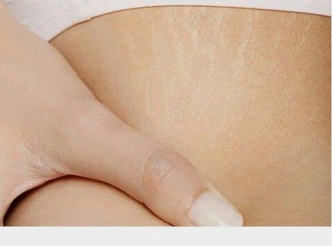 كيفية ازالة أثر علامات التمدد أوالسطور من الجلد بعد الحمل او انقاص أو زيادة الوزن