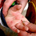 ΠΡΟΣΟΧΗ: Ο ιός Κοξάκι σε έξαρση στα παιδιά! Δείτε πώς θα προφυλαχθείτε