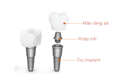 Trồng răng implant có đau không? 1