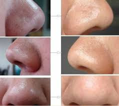 Nose oil, nasal sebum