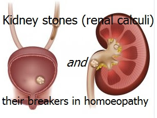 Kidney stones (renal calculi) and their breakers in homoeopathy