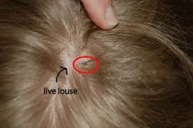 Lice Information