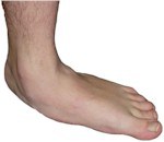  Fisioterapi  fisioterapi  pada flat foot 