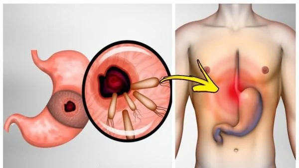 Bacterium Causes Heartburn And Bloating