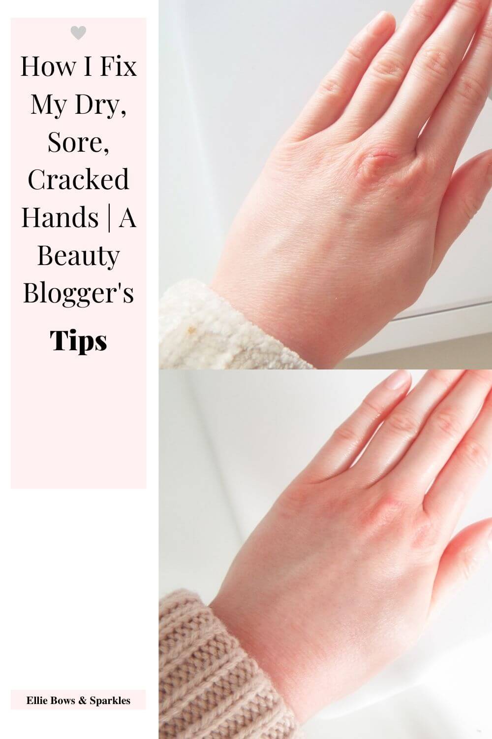 Pinterest pin, with picture of dry, sore, cracked hands to top right and healed hands to bottom right. A pink, rectangular title card sits to the left, reading "How I Fix My Dry, Sore, Cracked Hands | A Beauty Blogger's Tips" in black text, with bold accents and a little grey heart above.