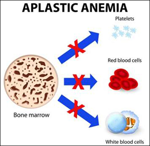 Severe Aplastic Anaemia, Ayurvedic Treatment