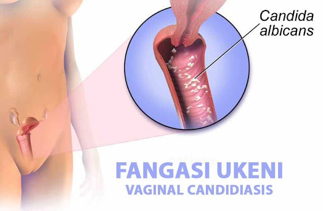 UGONJWA WA FANGASI ZA UKENI/ SEHEMU ZA SIRI(VAGINAL THRUSH)