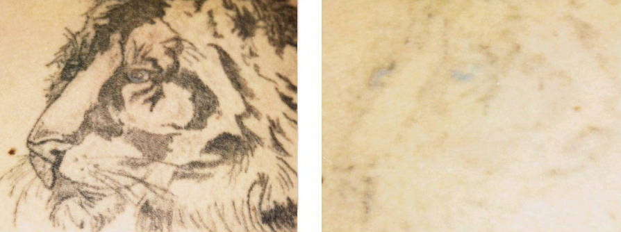 Different lasers are necessary to treat different colors within a tattoo
