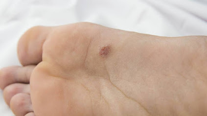 Wart Laser Therapy