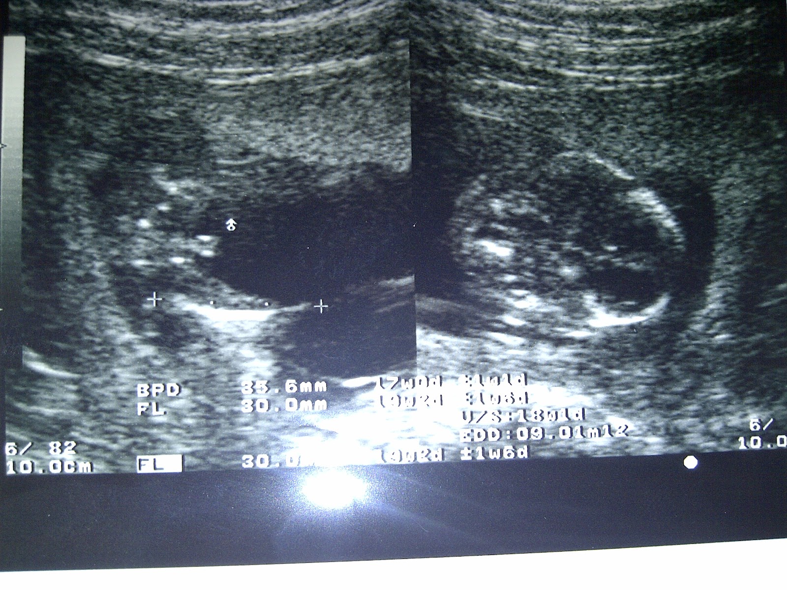 nathanaEL renantO 18 minggu kehamilan USG  2  Dimensi  