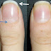 Nail Matrix Damage