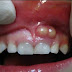 The 6 of kind Danger of a Lump on Gums and Causes