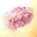 Bruise - What Causes Easy Bruising