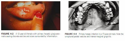 CLINICAL MANIFESTATIONS OF PRIMARY ORAL HERPES