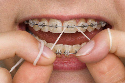 Lợi ích của các phương pháp niềng răng