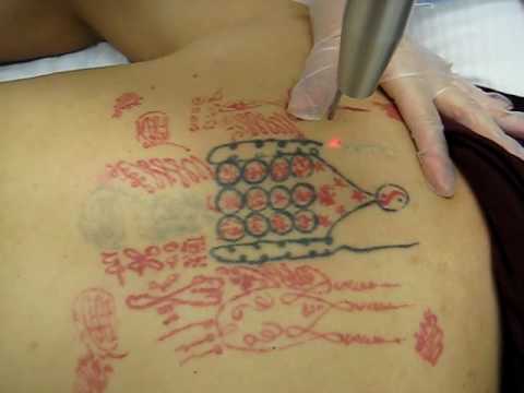 treatments 12 average tattoo removal cost per treatment $ 98