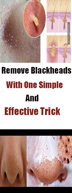 Remove Blackheads With One Simple And Effective Trick