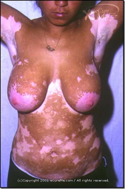 Vitiligo550_ab