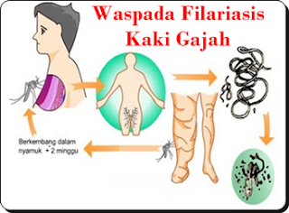 Obat Herbal Filariasis Limfatik