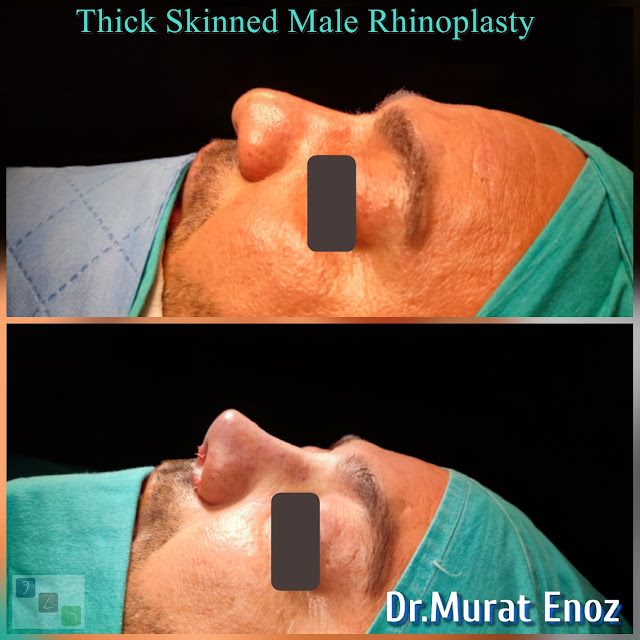 thick skinned rhinoplasty for men - oily thick skinned nose job