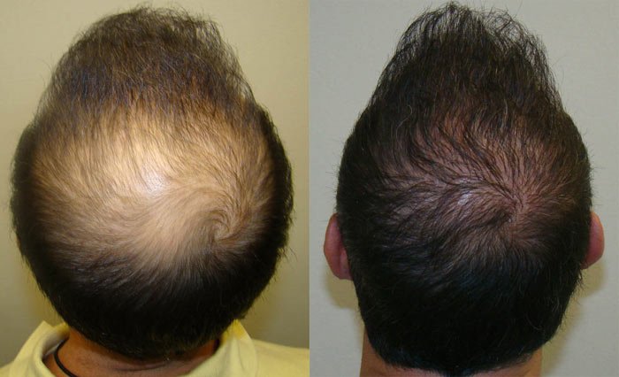 Hair Loss Treatment for Men । Result । Health n Beauty HuB