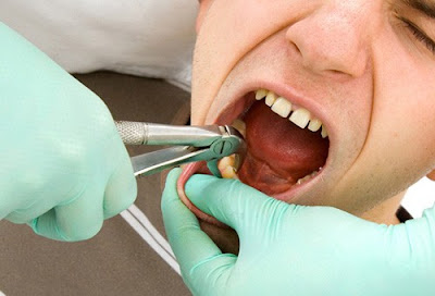  Hậu quả niềng răng sai cách là gì? 