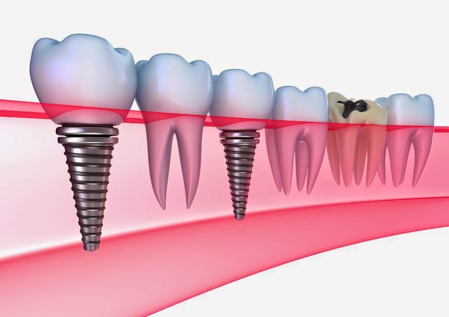  Dental Implant Clinics in India 