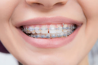Complete Guide to a Confident Smile - Dental implants near me