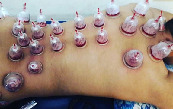 Benefits of Hijama Cupping Therapy