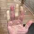 Raynaud’s syndrome